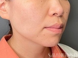 症例NO.74703のBEFORE写真