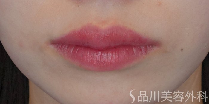 症例NO.72045のAFTER写真