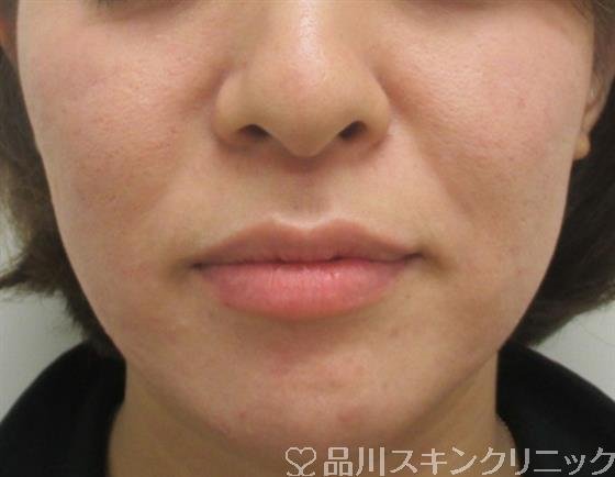 症例NO.26355のBEFORE写真