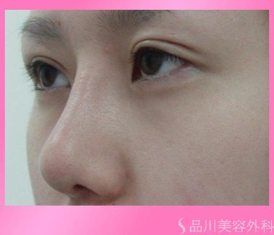 症例NO.7129のAFTER写真