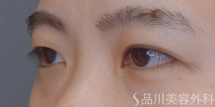症例NO.74847のBEFORE写真