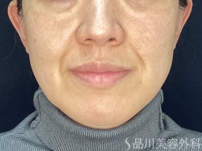 症例NO.71995のBEFORE写真