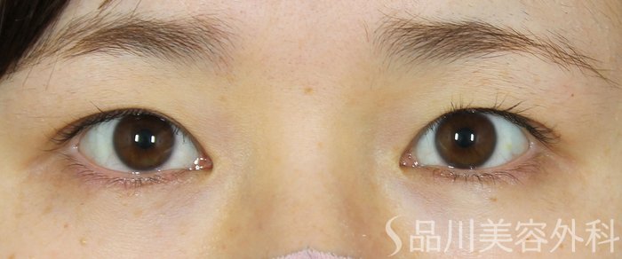 症例NO.69581のBEFORE写真