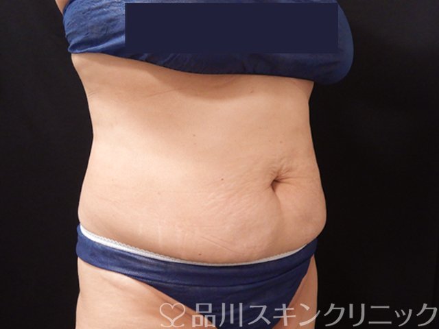 症例NO.68086のAFTER写真