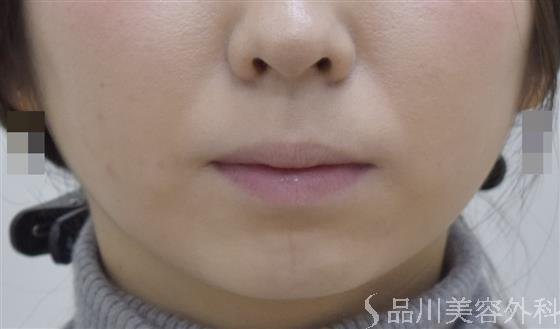 症例NO.46845のBEFORE写真