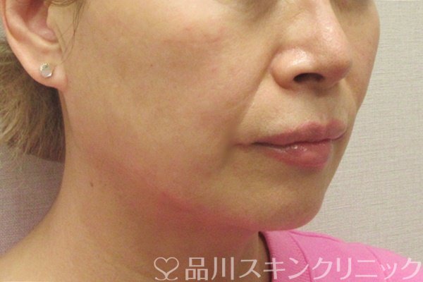 症例NO.72768のAFTER写真