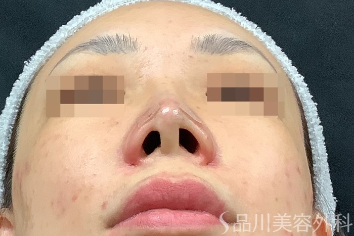 症例NO.71638のAFTER写真