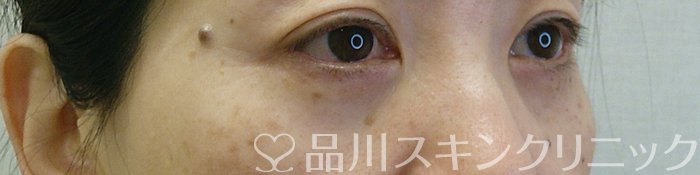 症例NO.69346のAFTER写真