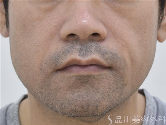 症例NO.43957のBEFORE写真