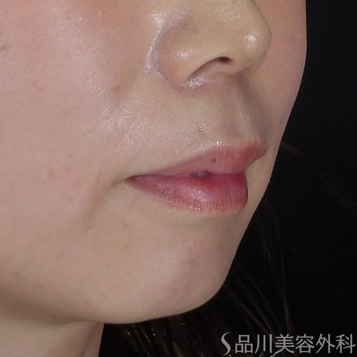 症例NO.71479のBEFORE写真