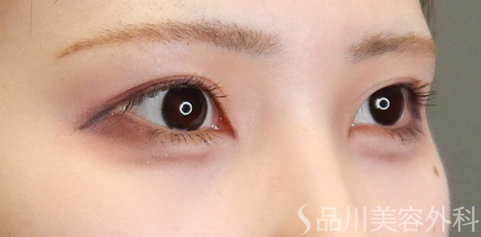 症例NO.65100のBEFORE写真
