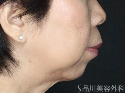 症例NO.72431のBEFORE写真