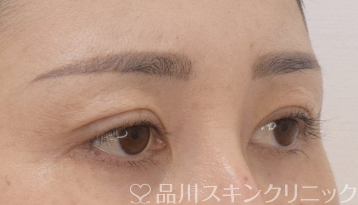 症例NO.75017のAFTER写真