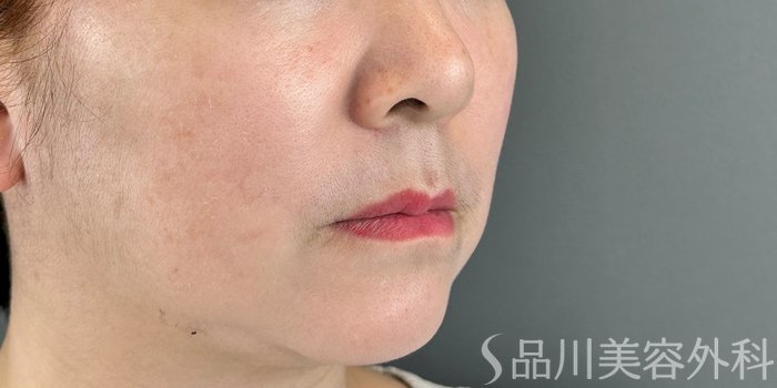 症例NO.70957のBEFORE写真