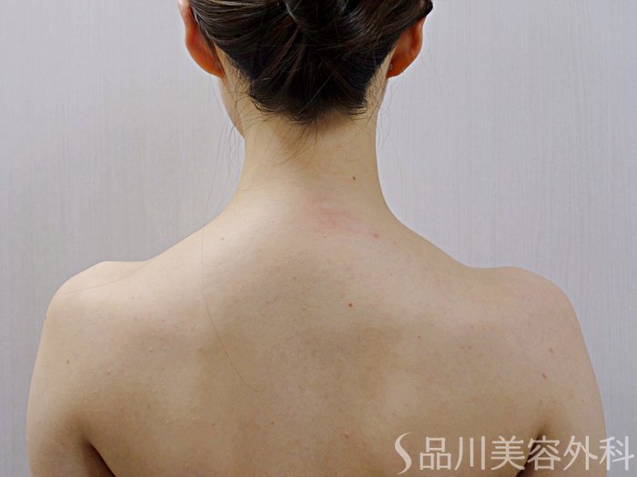 症例NO.74501のBEFORE写真