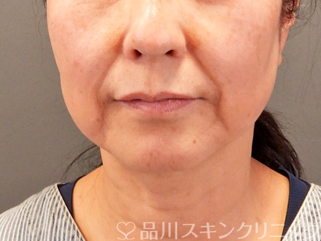 症例NO.70433のBEFORE写真