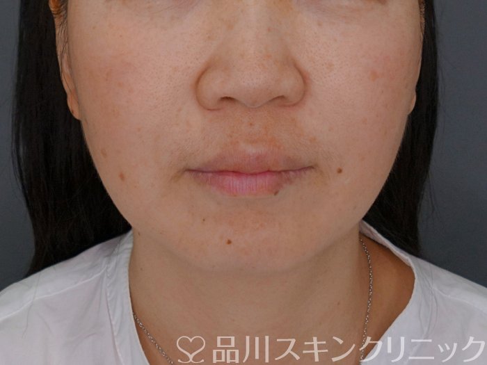 症例NO.74181のBEFORE写真