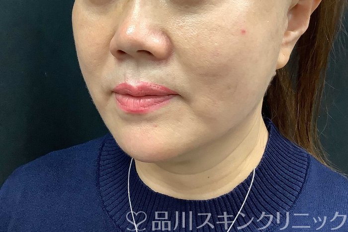 症例NO.71283のAFTER写真