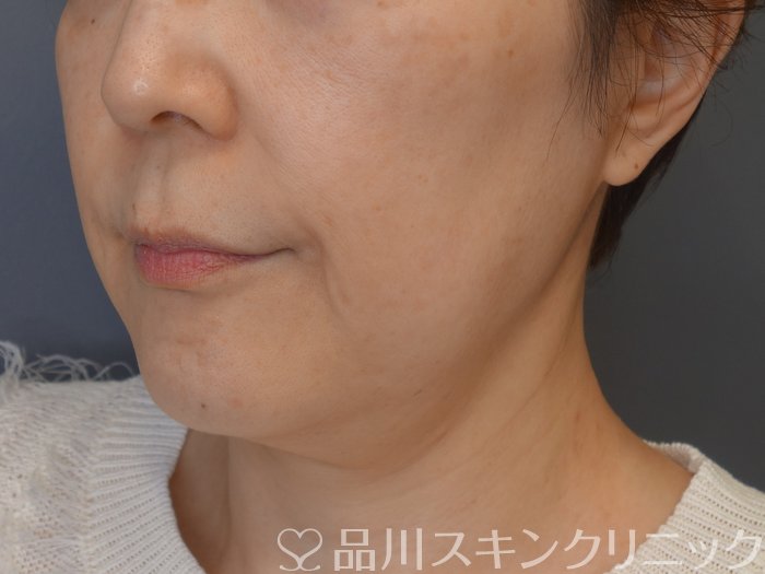 症例NO.72264のBEFORE写真