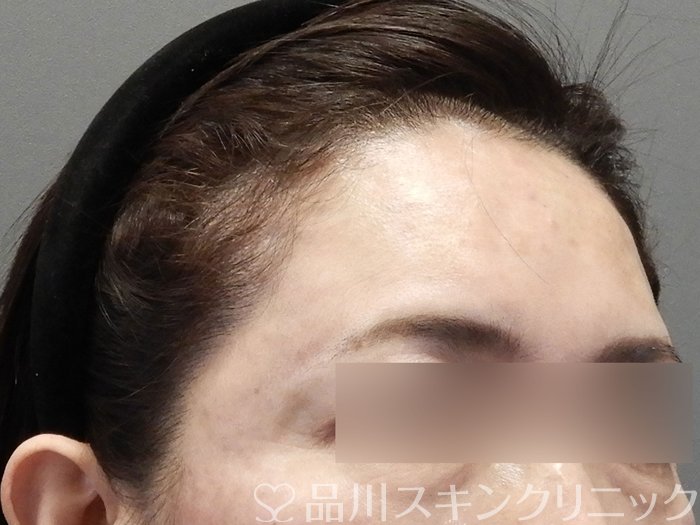 症例NO.74757のAFTER写真