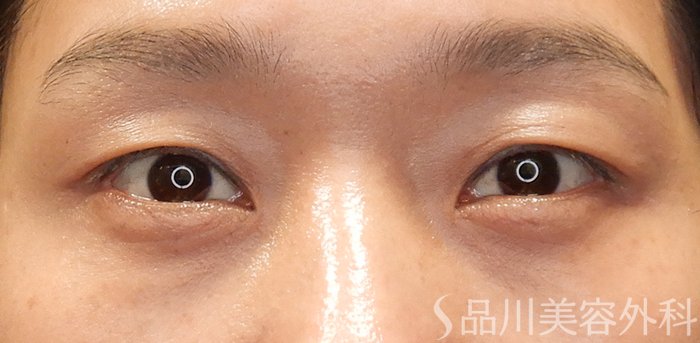症例NO.71337のAFTER写真