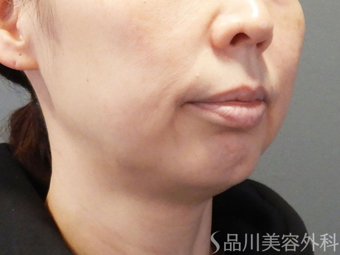 症例NO.74624のBEFORE写真