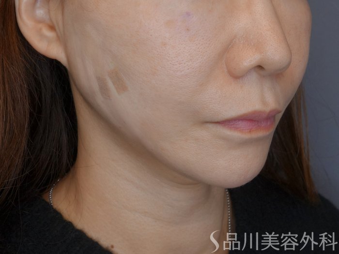 症例NO.72328のAFTER写真
