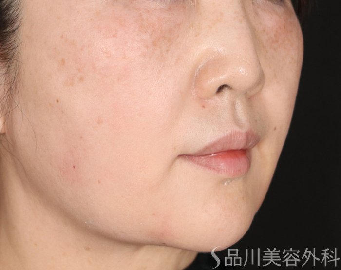 症例NO.72152のAFTER写真