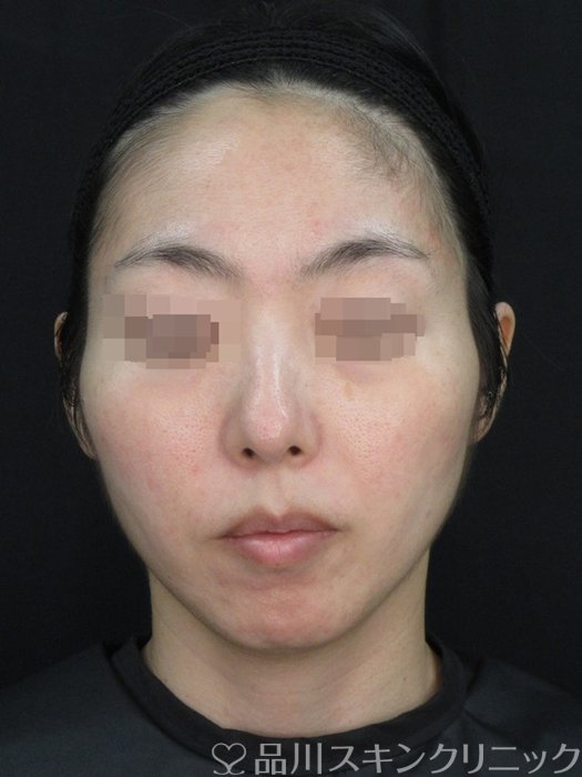 症例NO.72424のAFTER写真