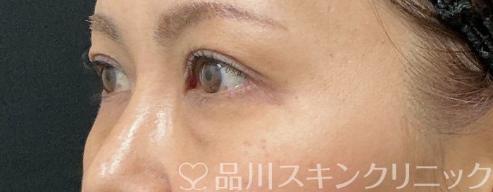 症例NO.74873のBEFORE写真