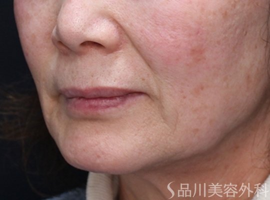 症例NO.73619のBEFORE写真