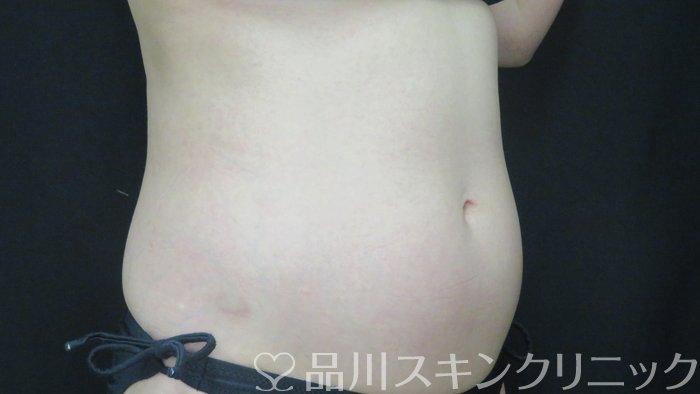症例NO.71120のBEFORE写真