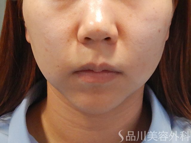 症例NO.74986のBEFORE写真