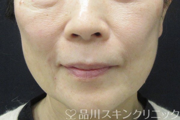 症例NO.67902のAFTER写真