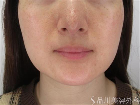 症例NO.47966のBEFORE写真