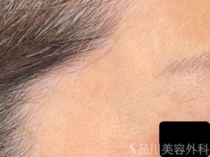 症例NO.65548のAFTER写真