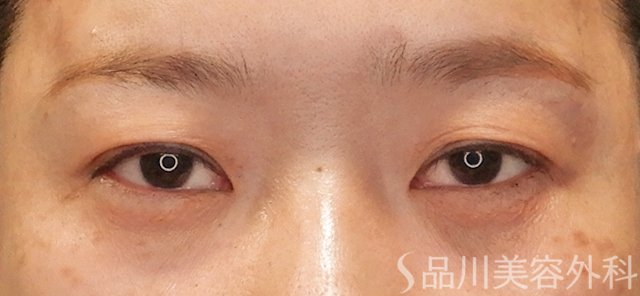 症例NO.72767のAFTER写真