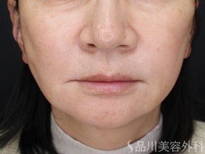 症例NO.69745のAFTER写真