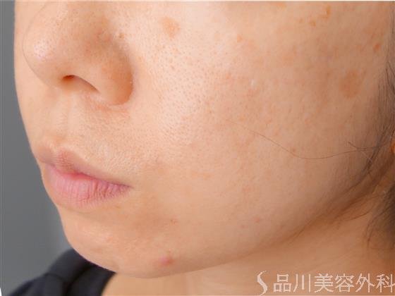 症例NO.51718のBEFORE写真