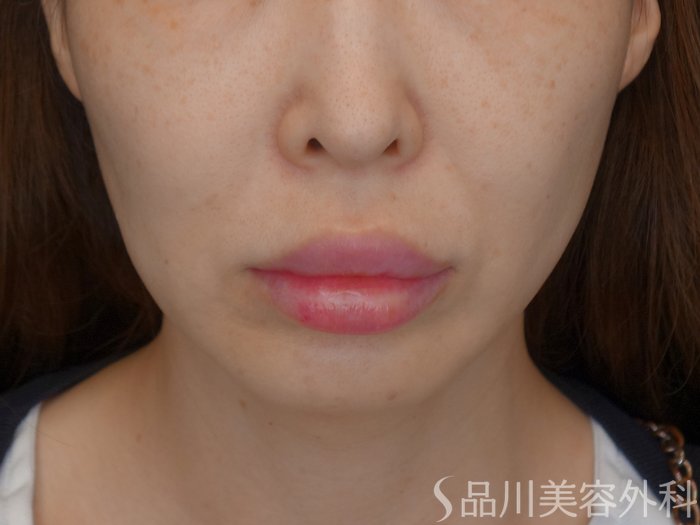 症例NO.71670のBEFORE写真