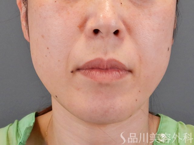 症例NO.75296のBEFORE写真