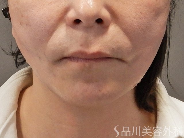 症例NO.72506のAFTER写真