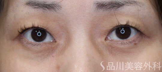 症例NO.69932のBEFORE写真