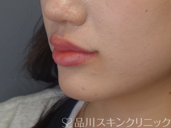 症例NO.74477のAFTER写真