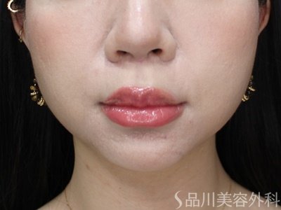 症例NO.69388のAFTER写真