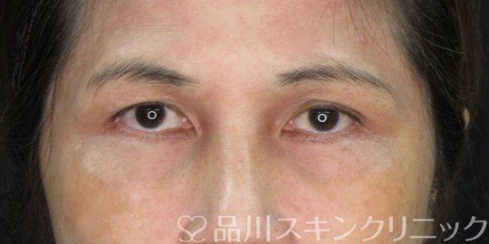 症例NO.75327のBEFORE写真