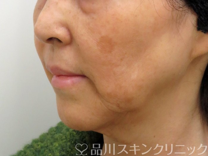 症例NO.73763のBEFORE写真