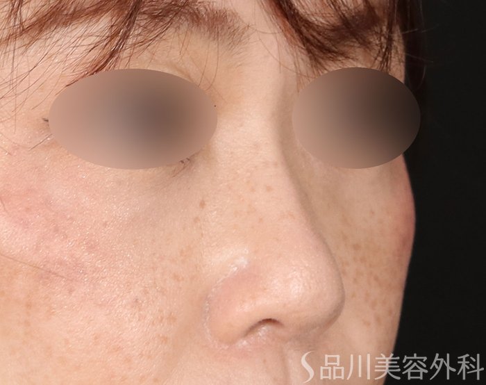 症例NO.71345のBEFORE写真
