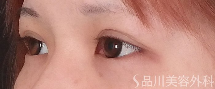 症例NO.69623のBEFORE写真