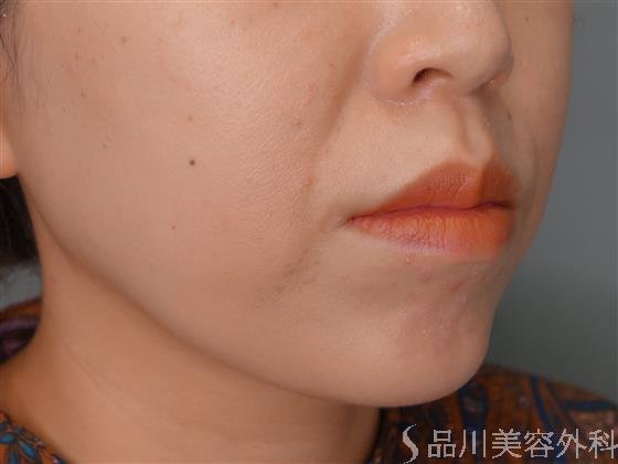 症例NO.53670のBEFORE写真